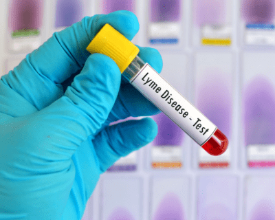 blood test for lyme disease in laboratory