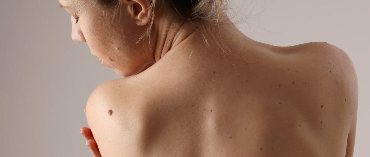 méthode pour examiner ses grains de beauté