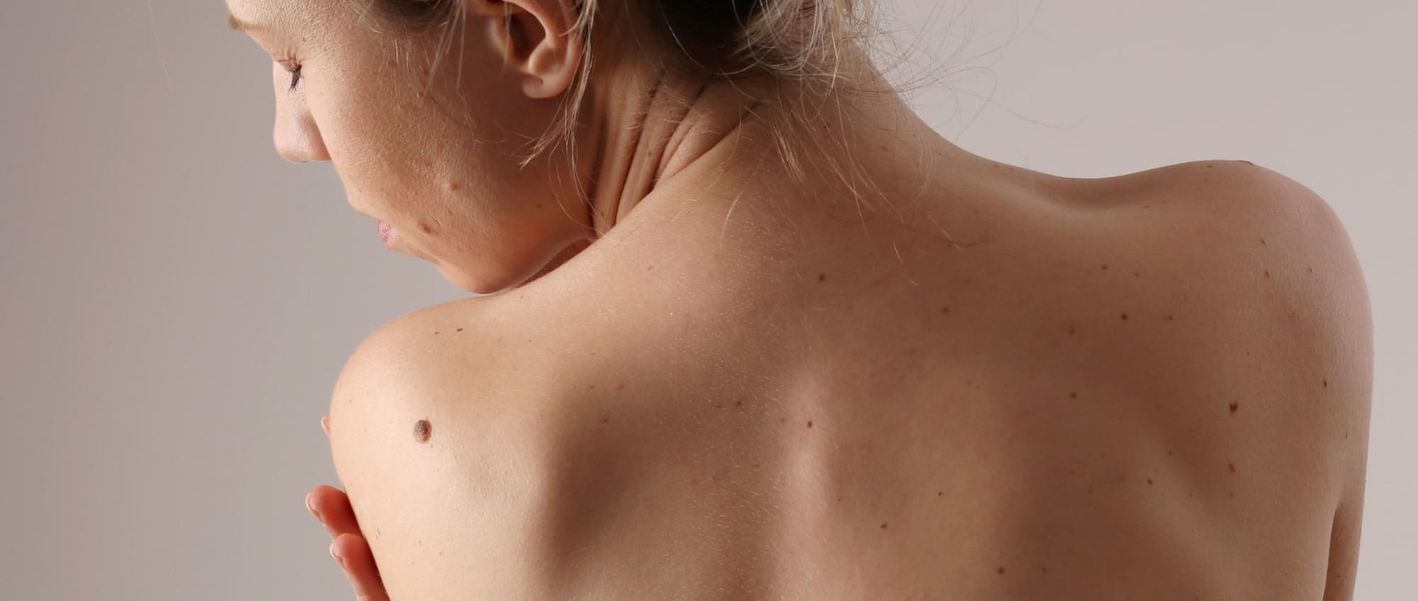 méthode pour examiner ses grains de beauté