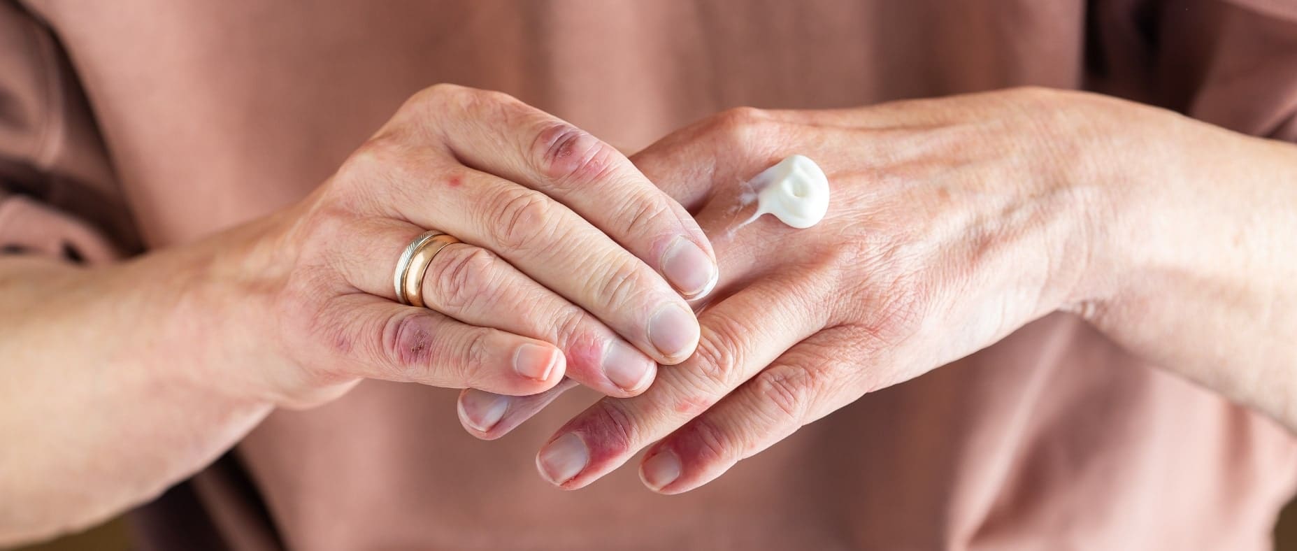 protecting your eczema and psoriasis in winter