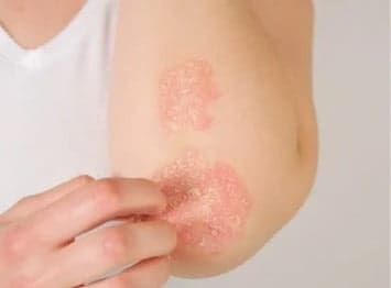 eczema outbreak
