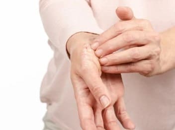 psoriasis outbreak