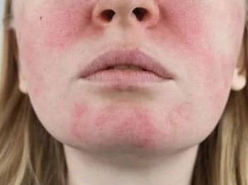 rosacea on face