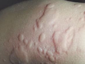 cold allergy
