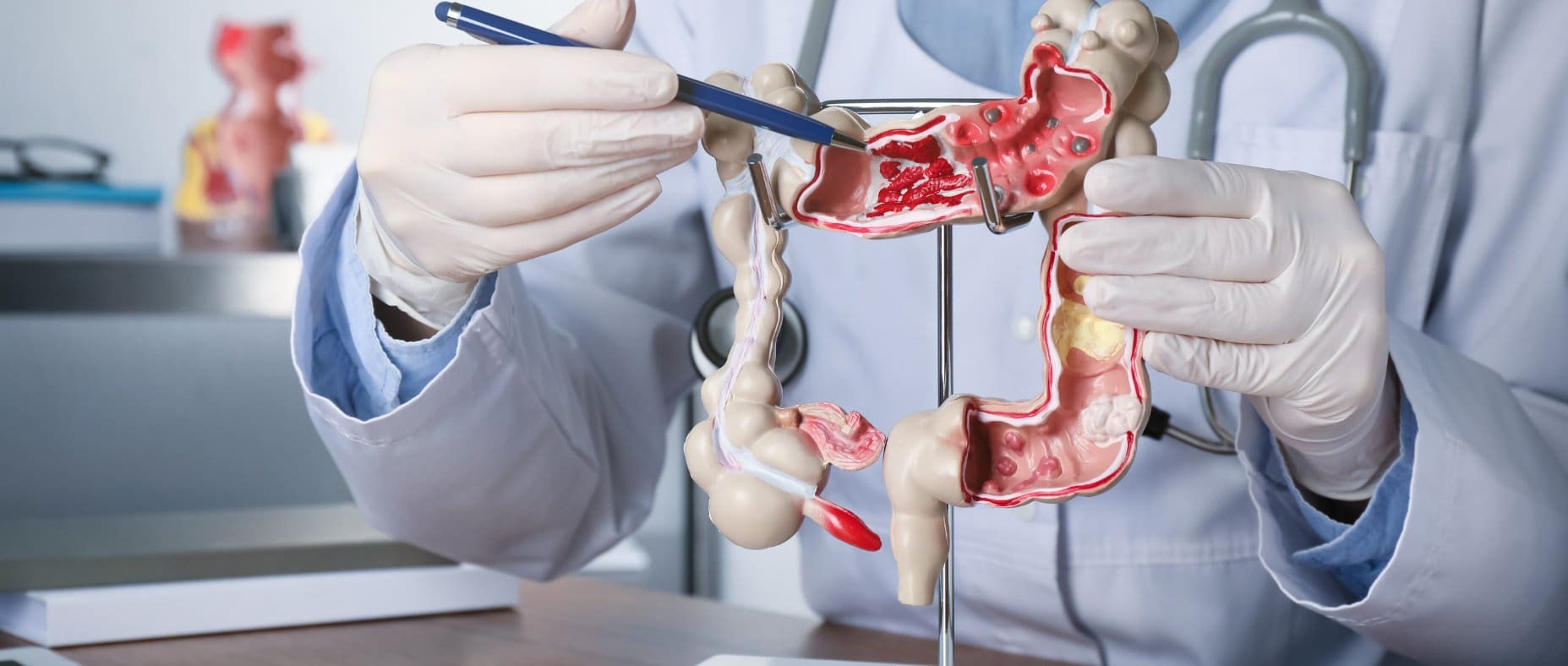 dépistage cancer colorectal